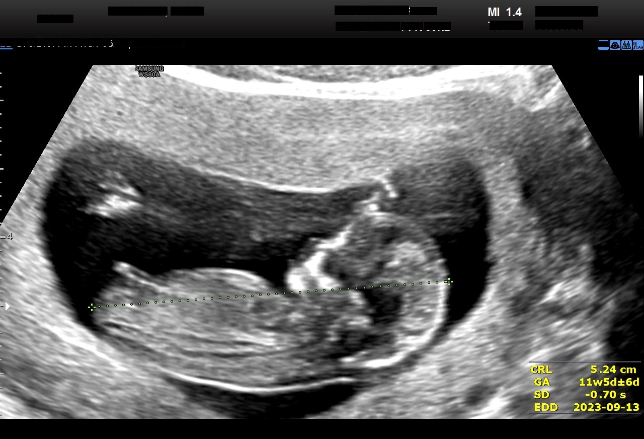 Fetal Ultrasound Analysis
